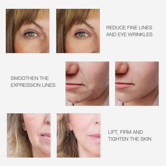 MLAY RF01 Radio Frequency (RF Technology) Skin Tightening Beauty Instrument - Picture 3 of 16